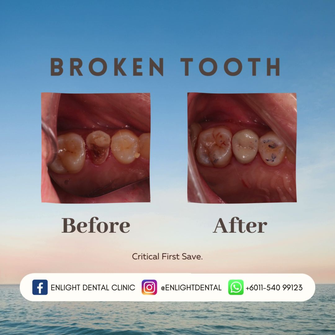 Enlight Dental - Braces and Invisalign Provider — dental clinic in Malaysia