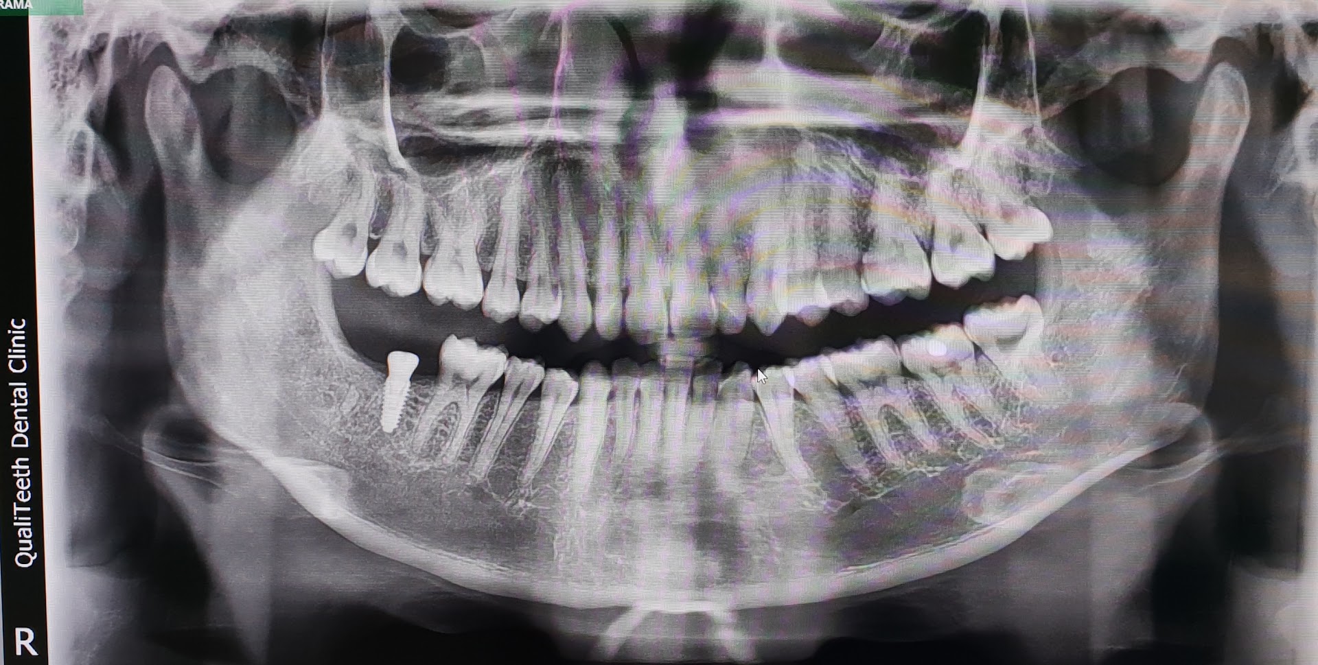 Qualiteeth Dental Clinic 优质牙科@ Rawang (Opens Everyday)- Braces Centre since 2017 — photo 4