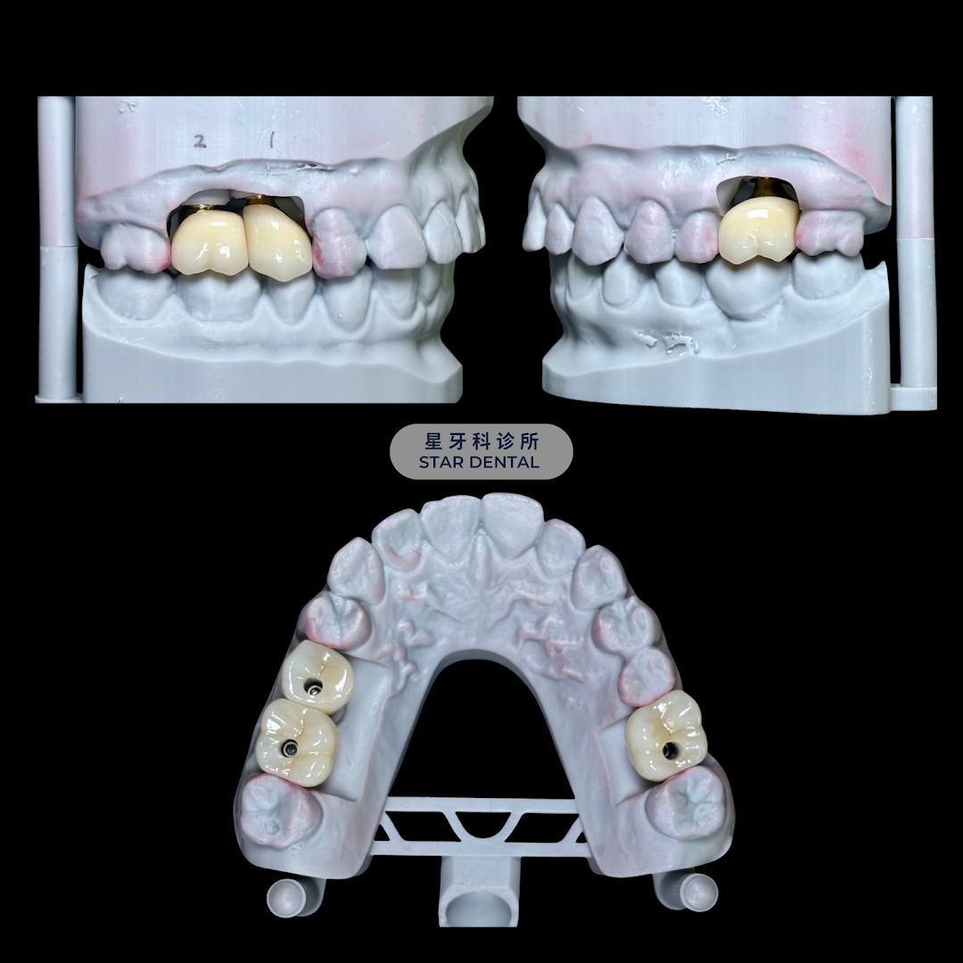 Star Dental Clinic Bukit Mertajam - Implant & Braces Centre 大山脚星牙科 种植牙和绑牙中心 — photo 4