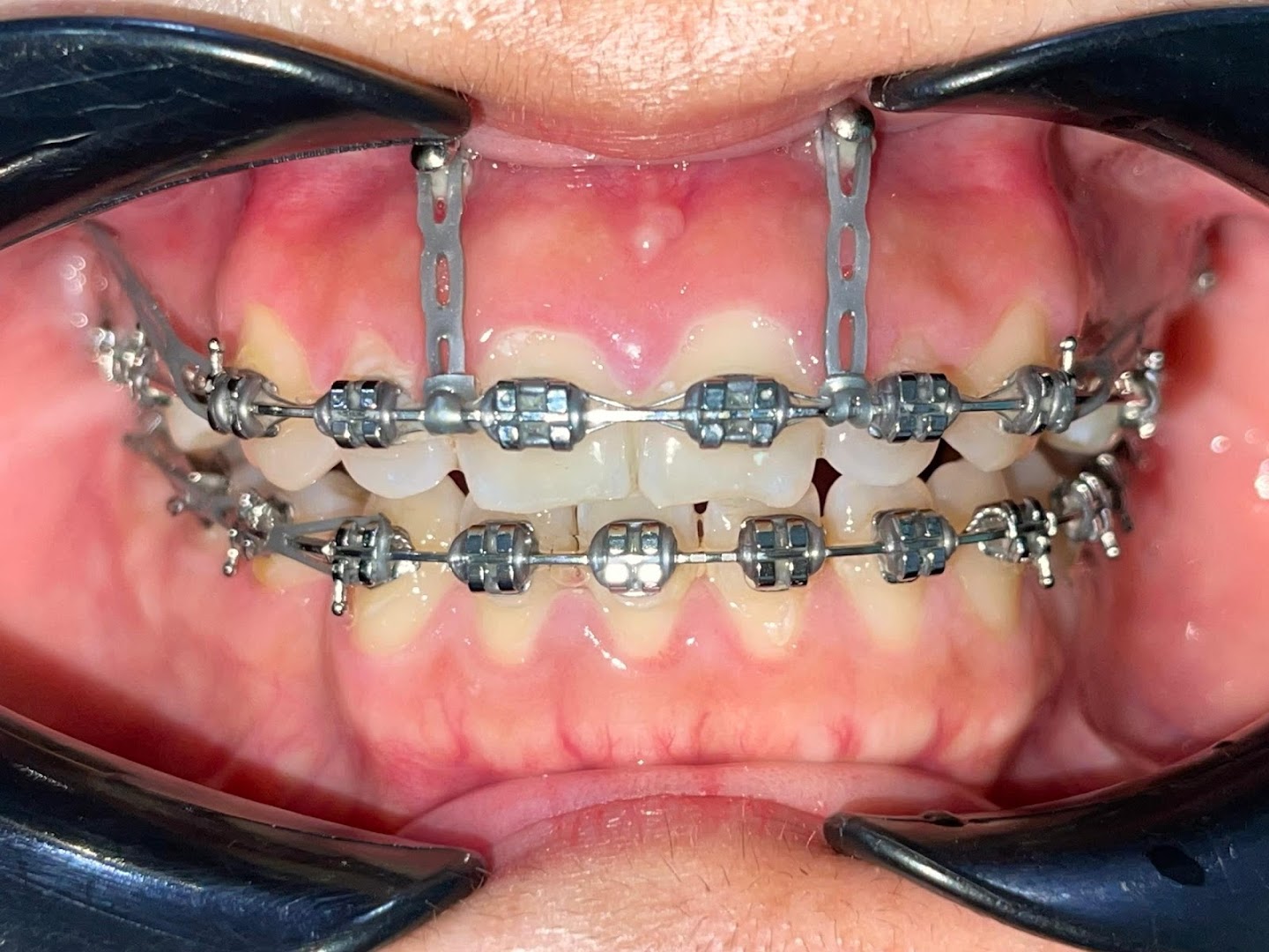 T Care Dental Clinic Puchong (Bandar Puteri) Braces & Implant Specialist — photo 5